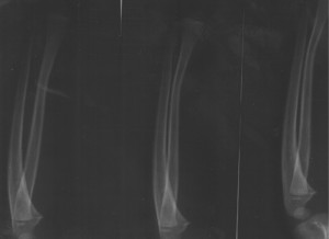 Xavier's X-Ray showing the Greenstick Fracture - 06/02/2008